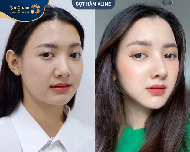 Chăm sóc tốt để có kết quả gọt hàm ưng ý