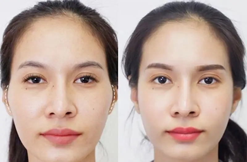 Hạ gò má hết sưng hoàn toàn sau 1 tháng