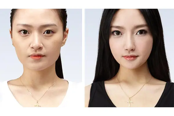 Phẫu thuật hạ gò má an toàn, hiệu quả