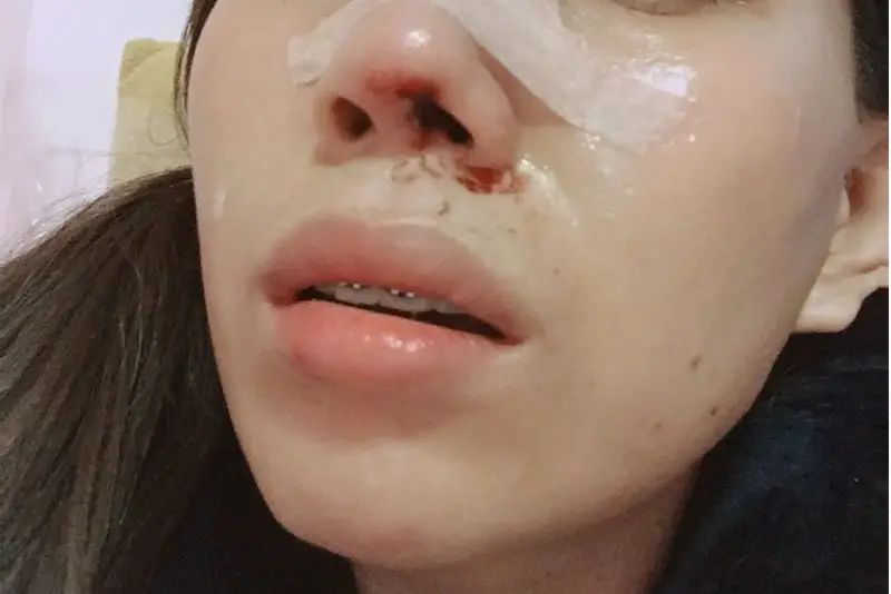 Nếu thấy mũi chảy máu hay có biểu hiện lạ, cần thăm khám ngay
