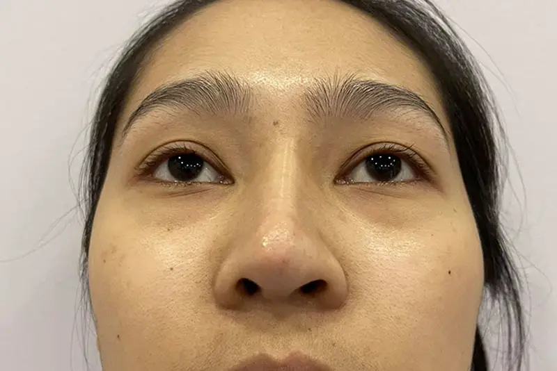 Hắt xì quá mạnh khiến mũi bị lệch