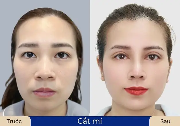 Sau 7 - 10 ngày mí mắt sẽ ổn định, vào form đẹp tự nhiên