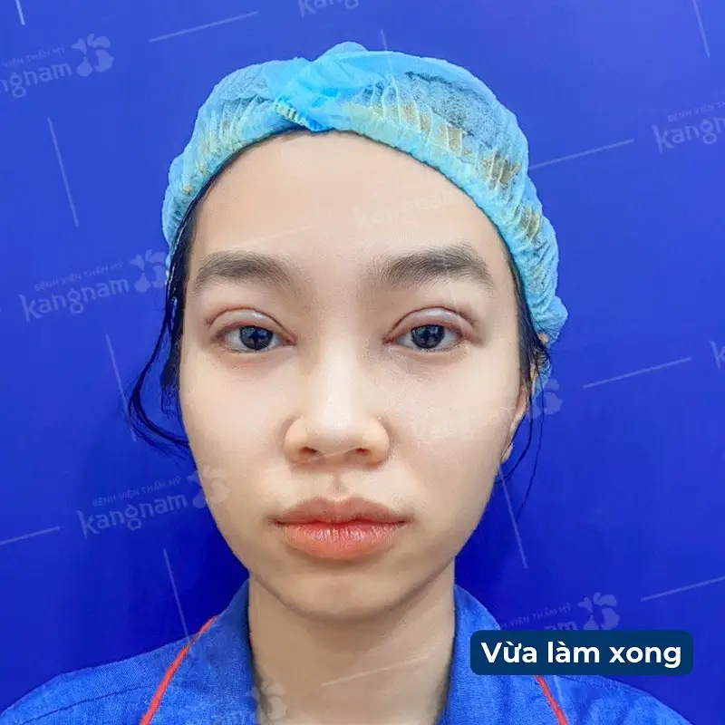 Sau khi cắt mí sẽ gặp tình trạng mí mắt bị sưng tấy, bầm tím