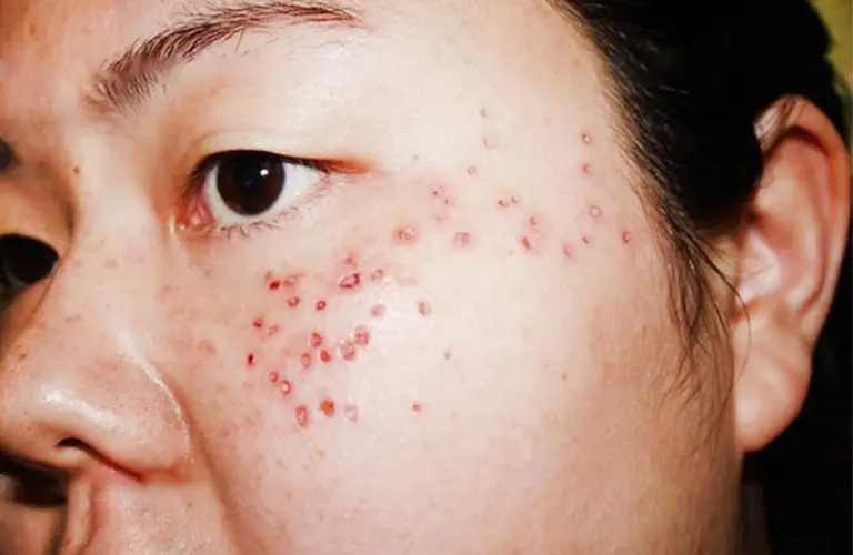 Chấm tàn nhang không được khuyến khích vì tiểm ẩn nhiều rủi ro 