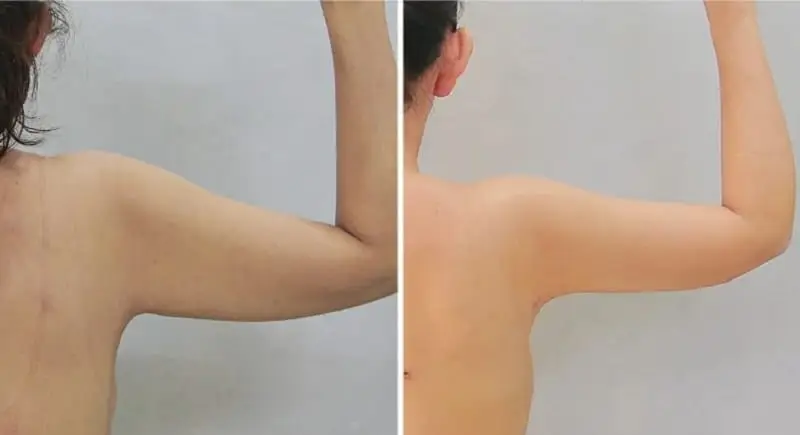 Hút mỡ bắp tay sẽ lành lại sau 7 - 10 ngày