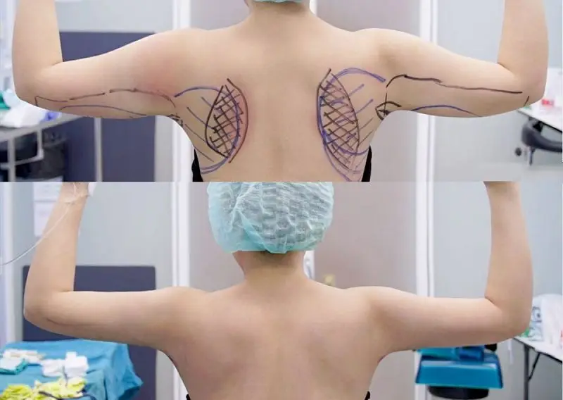 Sau khi phục hồi vùng cánh tay của khách hàng sẽ thon gọn, săn chắc hơn