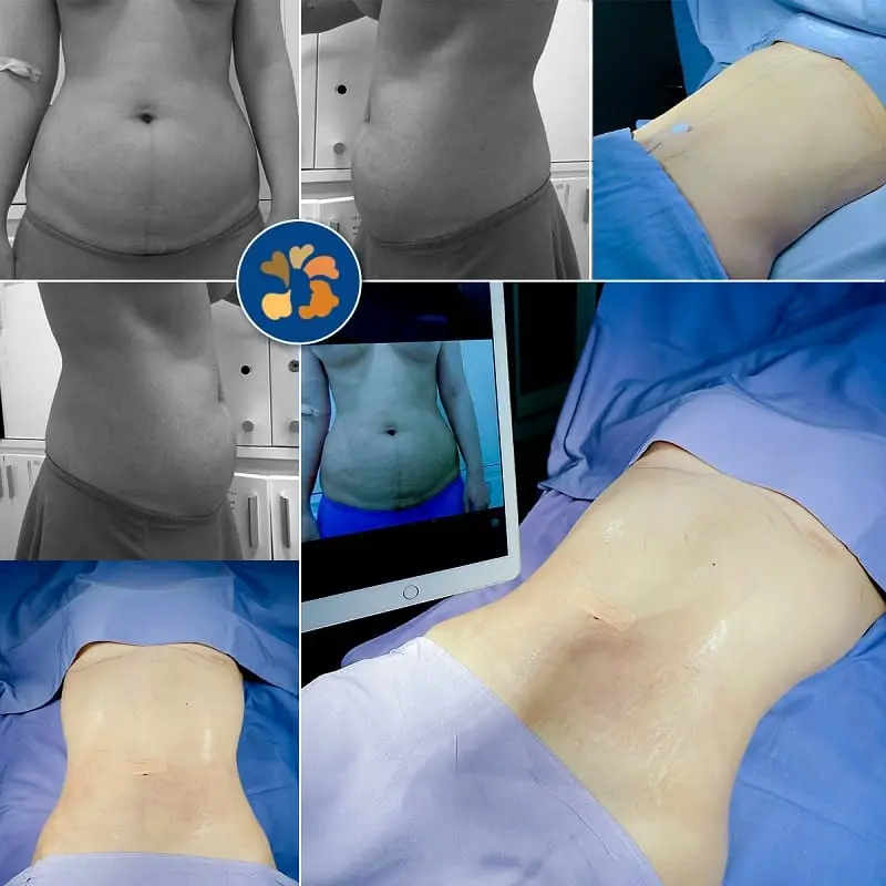 Hút mỡ bụng không gây đau vì khách hàng sẽ được tiêm gây mê trước khi thực hiện