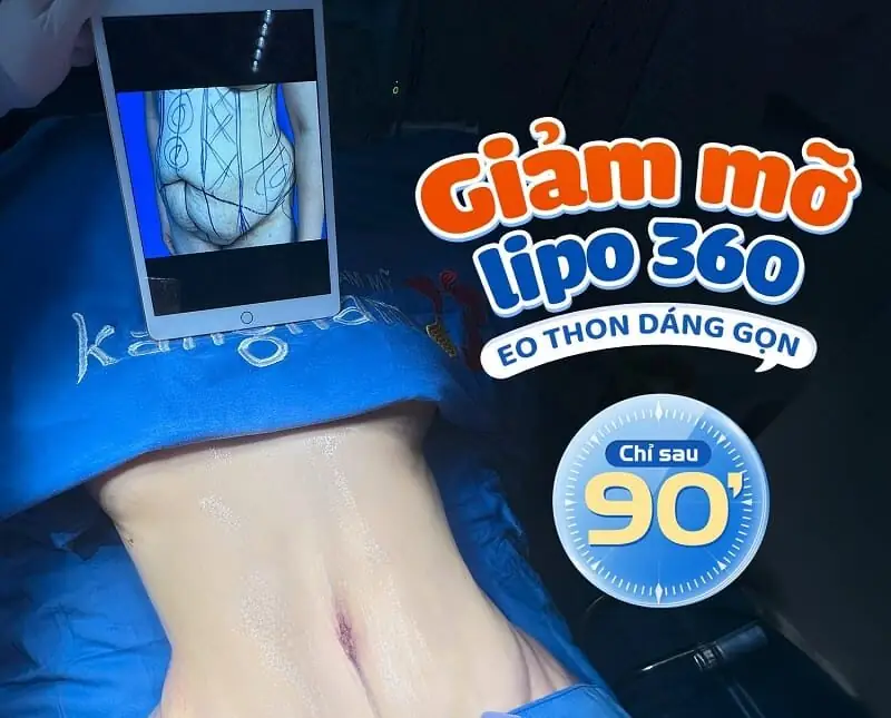 giảm mỡ Lipo 360 eo thon dáng gọn sau 90 phút