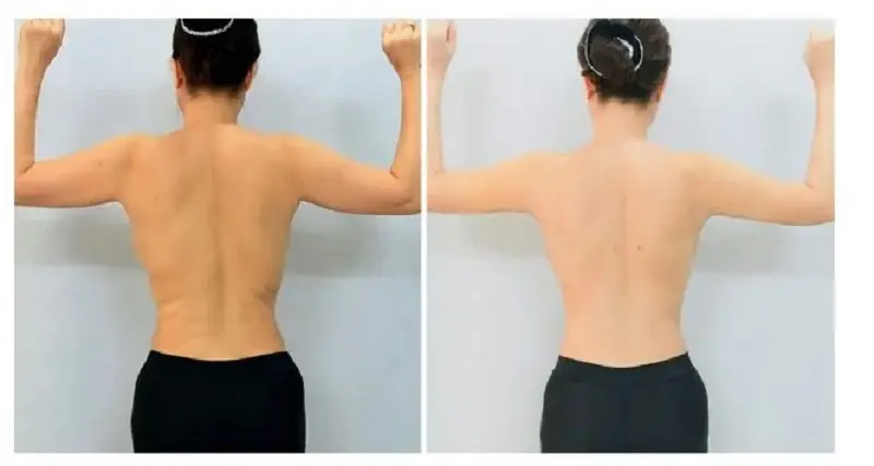 Chi phí hút mỡ nách và bắp tay phụ thuộc vào rất nhiều yếu tố