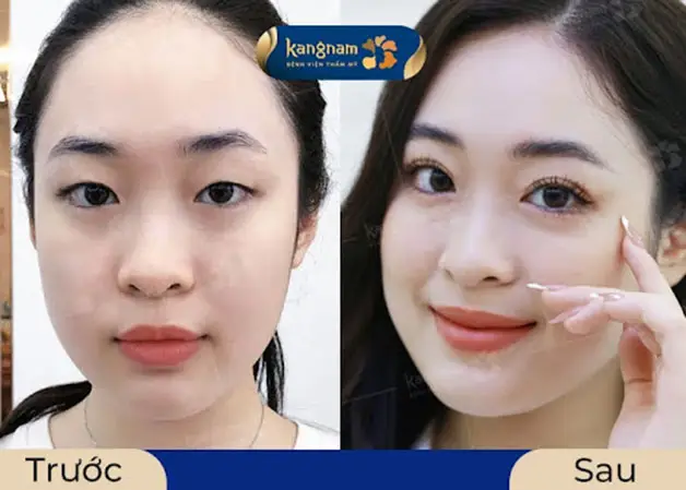 Tuân thủ tốt hướng dẫn bác sĩ để mí hồi phục nhanh và hiệu quả