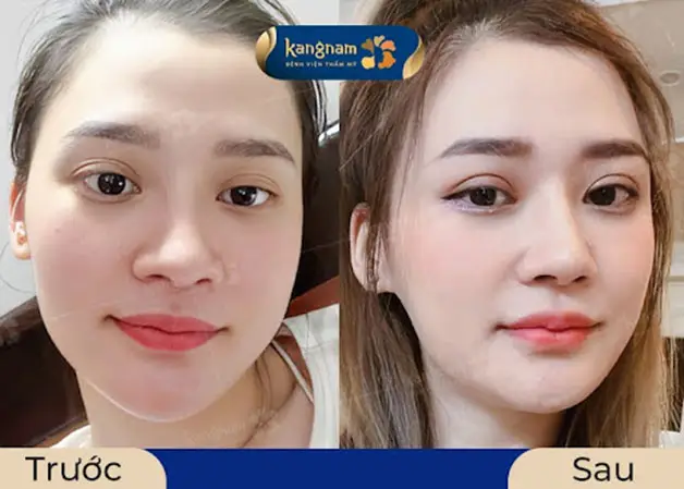 Kiêng khem đúng cách để có kết quả cắt mí ưng ý