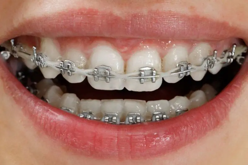 Kết hợp niềng răng chỉnh sửa mặt lưỡi cày trong một số trường hợp