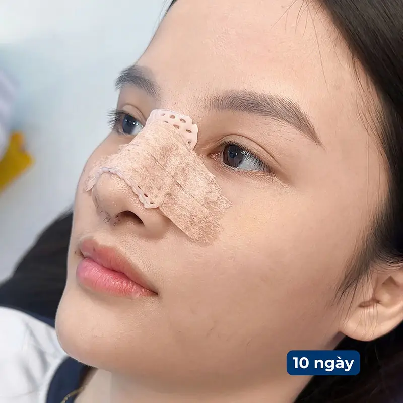 Mũi bị nhức trong thời gian đầu là bình thường