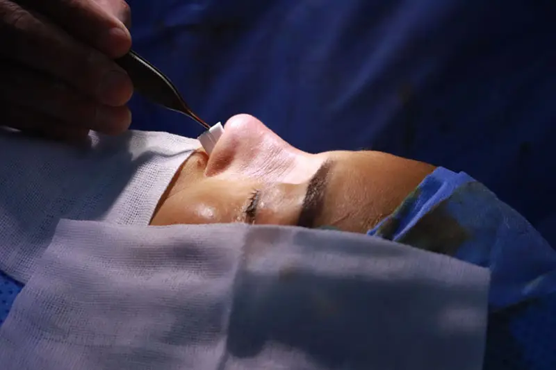 Quá trình nâng mũi không đau