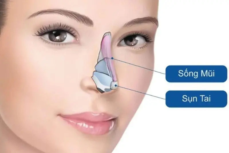 Nâng mũi sụn vành tai không đau vì được vô cảm