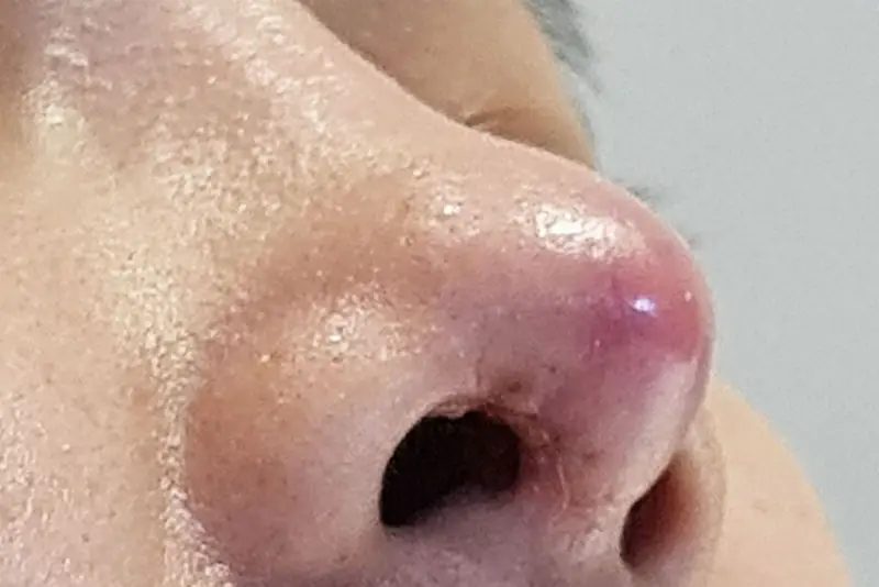 Mũi sưng đỏ, đau nhức cần thăm khám kịp thời