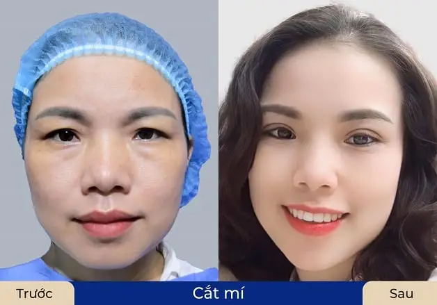 Khách hàng nên nâng cung mày nếu da mí mắt xuất hiện nhiều mỡ thừa do lão hóa, còn mí mắt 1 mí, mí sụp, nhiều da dư và mỡ thừa thì nên cắt mí