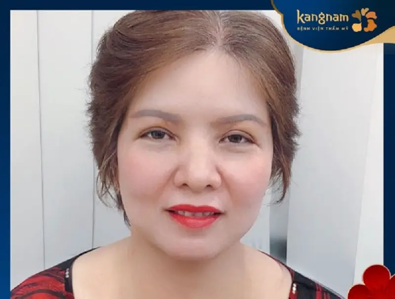 nâng cung mày giúp định hình chân mày, loại bỏ da dư thừa