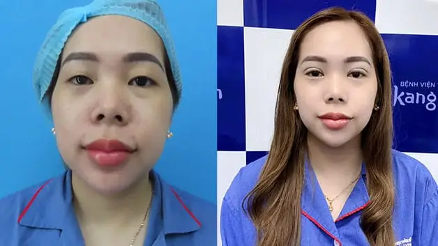  Nếp mí rõ ràng sau khi nhấn mí plasma