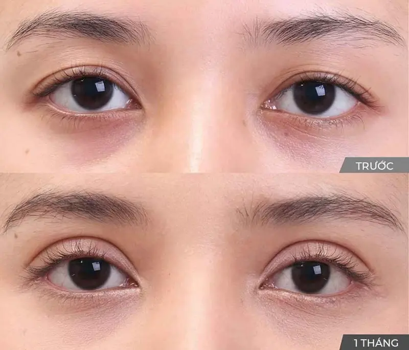 Nếp mí rõ ràng, cân đối sau khi nhấn mí plasma