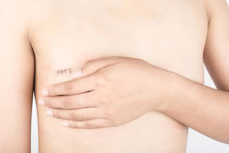 Phẫu thuật cắt bỏ ngực