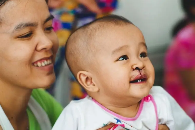 Hở hàm ếch nên thực hiện phẫu thuật sớm