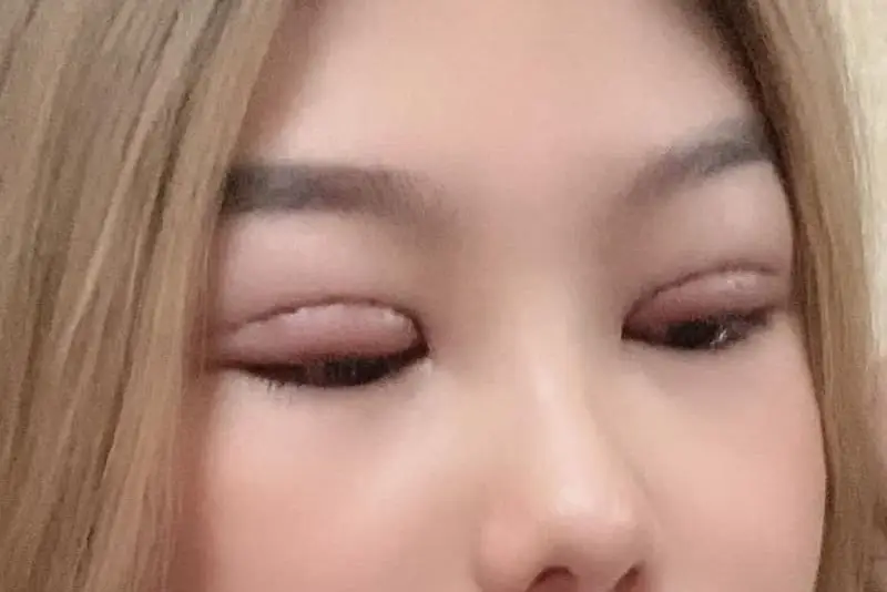 Ăn nhiều trứng sau cắt mí có thể khiến mí bị sưng