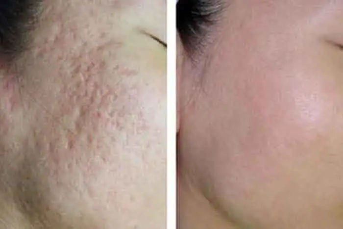 Hình ảnh khách hàng sau sau khi thực hiện xong liệu trình bắn laser