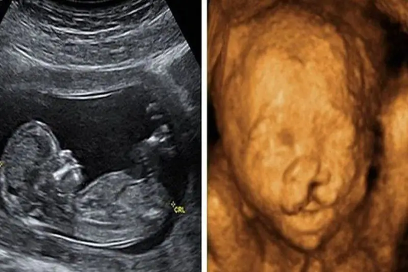 Siêu âm giúp phát hiện hở hàm ếch ở thai nhi