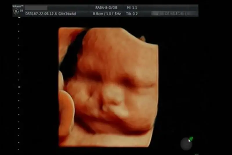 Siêu âm thai phát hiện hở hàm ếch