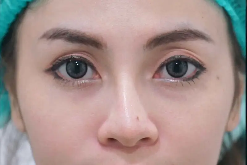 Sụn mũi cong vẹo sau phẫu thuật