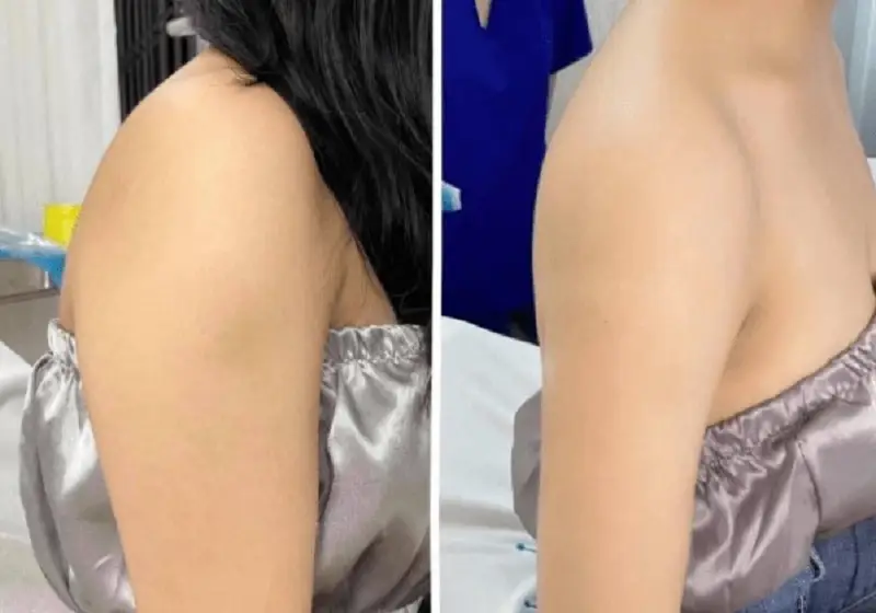 Mỡ nách, mỡ cánh tay được loại bỏ hiệu quả