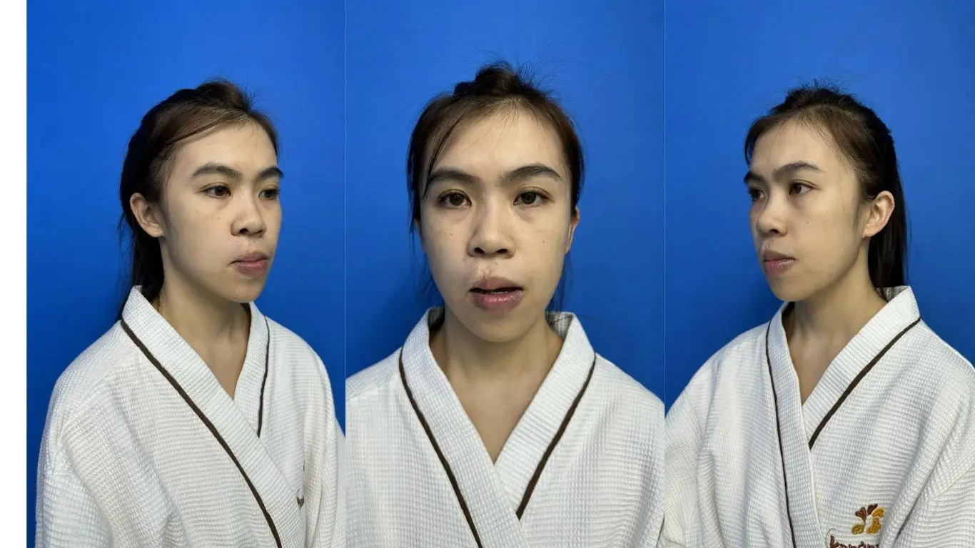 Mũi bị lệch, vẹo có thể cân nhắc sửa mũi