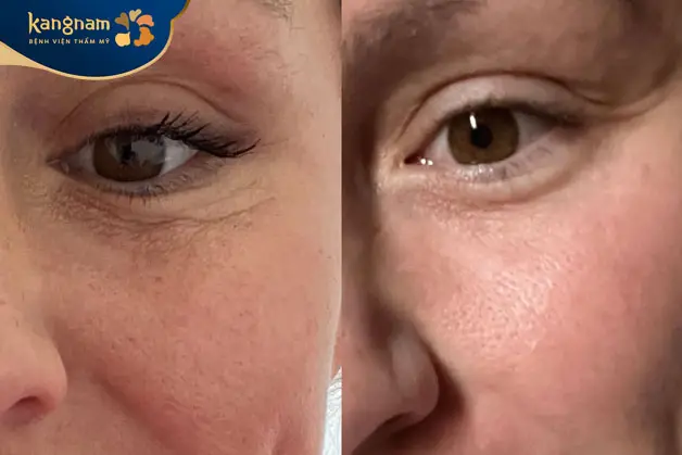 Chăm sóc đúng cách để không tái lại tàn nhang