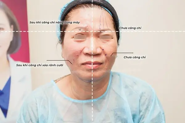 Căng chỉ da mặt sẽ xảy ra tình trạng sưng nhẹ