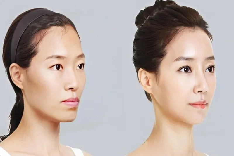 1CC filler tương ứng 1ml