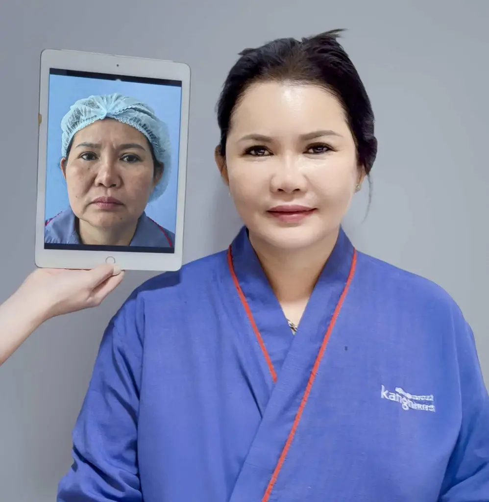 Phẫu thuật căng da mặt giúp gương mặt trẻ ra 5 - 10 tuổi