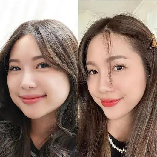 Tiêm botox gọn hàm giúp khuôn mặt thọn gọn, cân đối hơn 