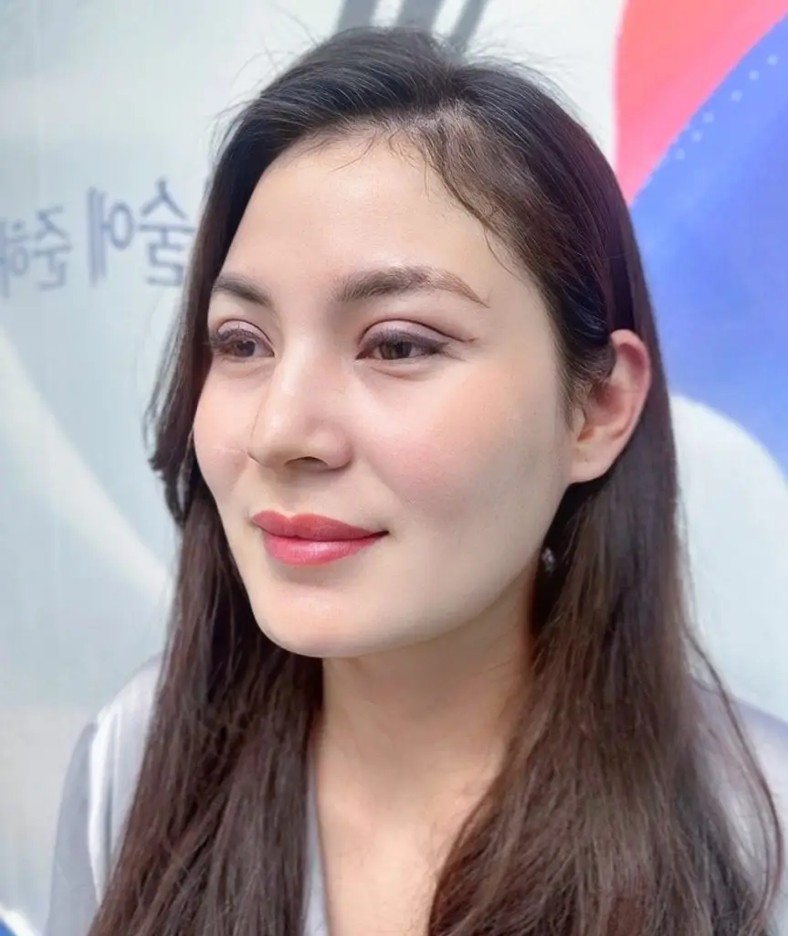 Sưng tấy, bầm tím nhẹ sau cắt mí sẽ giảm dần trong khoảng 5-7 ngày sau phẫu thuật