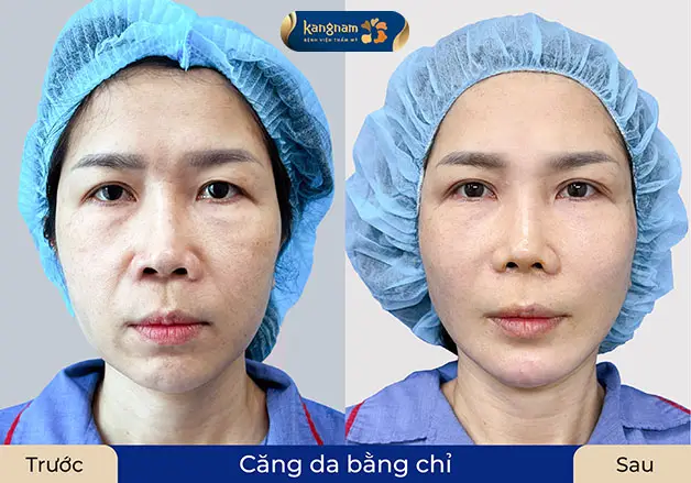 Khách hàng căng chỉ Xline sở hữu gương mặt trẻ trung, rạng rỡ hơn