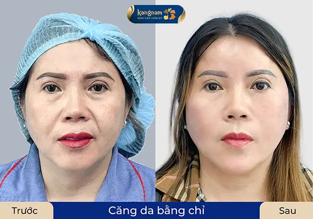Trước và sau căng chỉ da, da căng mịn không còn nếp nhăn