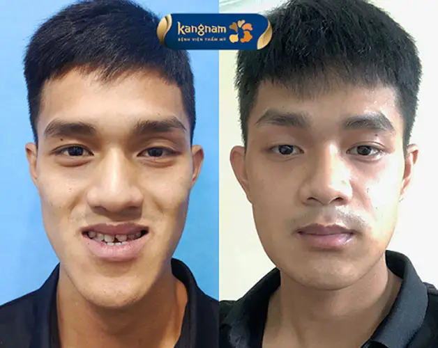 Chăm sóc đúng cách để đẩy nhanh quá trình lành vết thương sau phẫu thuật hàm móm