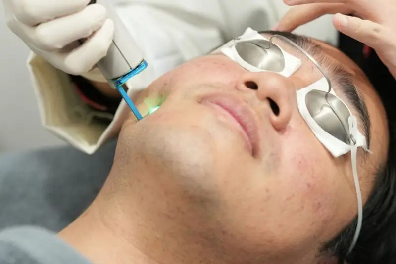 chiếu tia laser trị thâm mụn