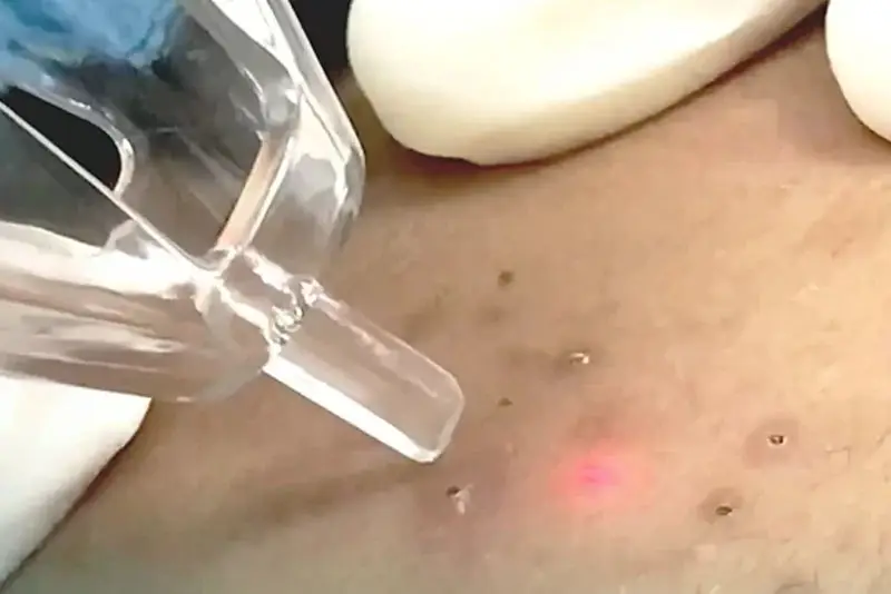 Bắn laser trị thâm mụn cần thời gian để thấy kết quả