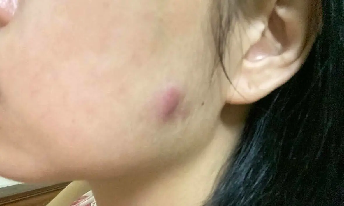 Tiêm botox gọn hàm có thể gây biến chứng nếu thực hiện sai kỹ thuật