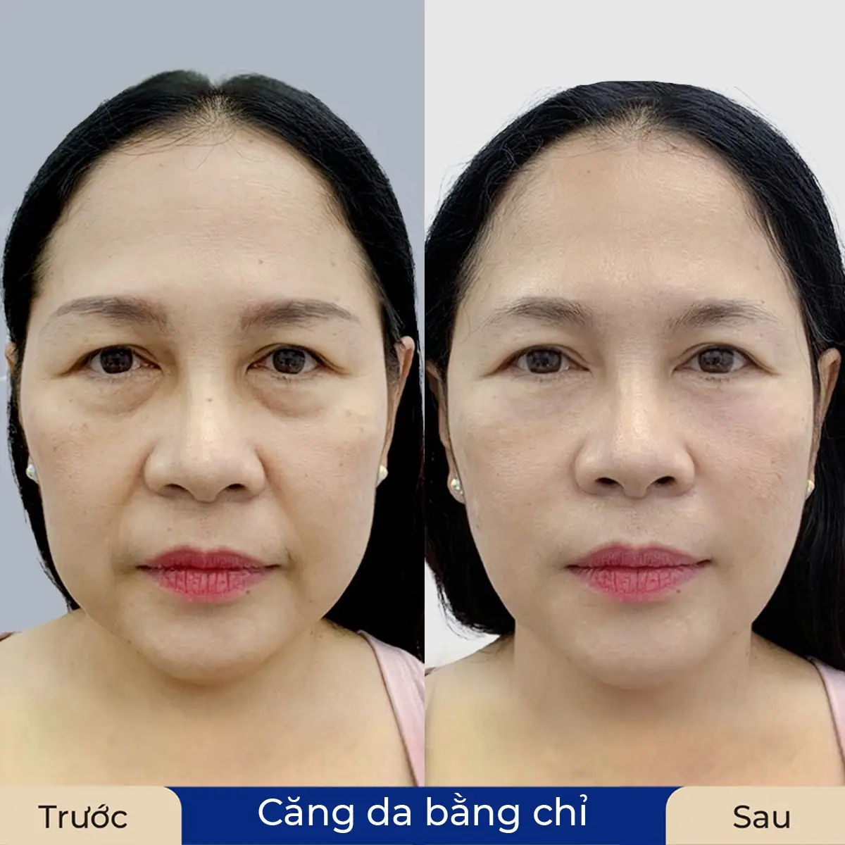 Làn da tươi trẻ, căng bóng sau khi căng da bằng chỉ