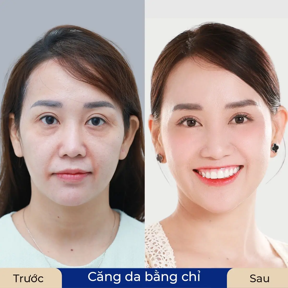 Cấy chỉ giúp khuôn mặt tười tắn, trẻ hơn 10 tuổi 