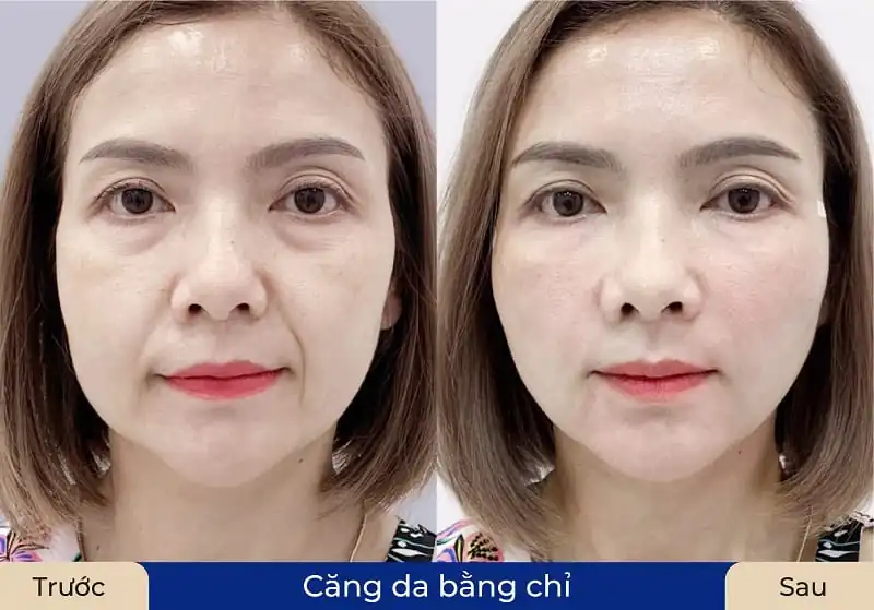 Làn da được kích thích sản sinh collagen sau căng chỉ