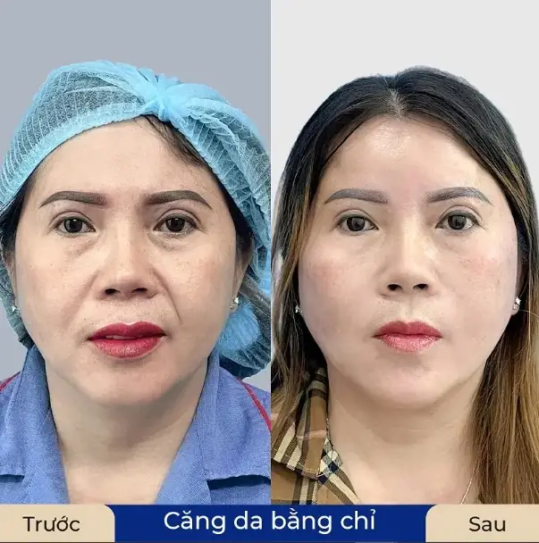 Căng chỉ tại Kangnam duy trì hiệu quả lâu dài