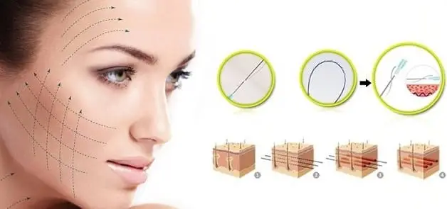 Căng chỉ collagen có chi phí rất đa dạng tùy thuộc vào mỗi cơ sở thẩm mỹ